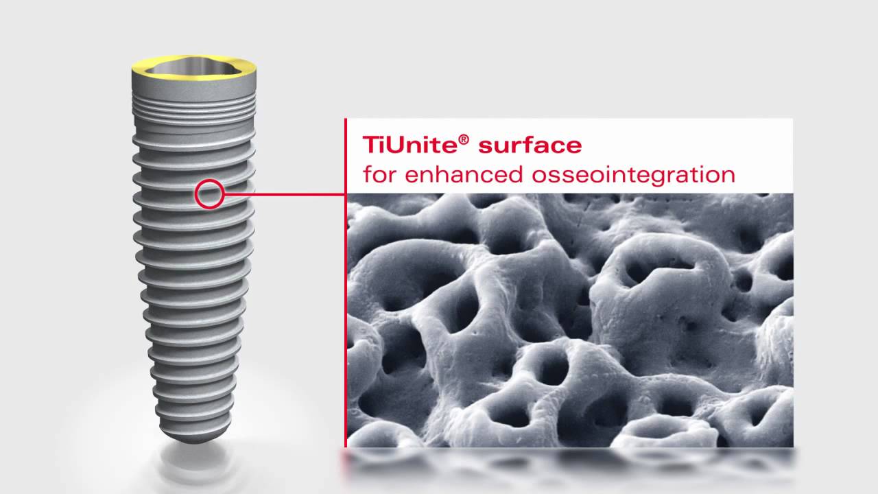 TiUnite surfase - разработка фирмы Нобель