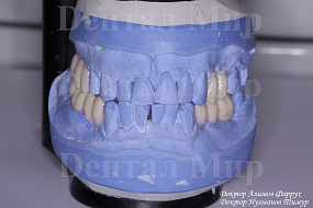 Фото моделирования waxup